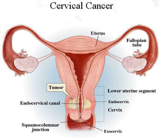 Cervical-Cancer-1
